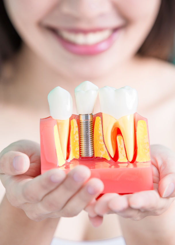 Dental Implants