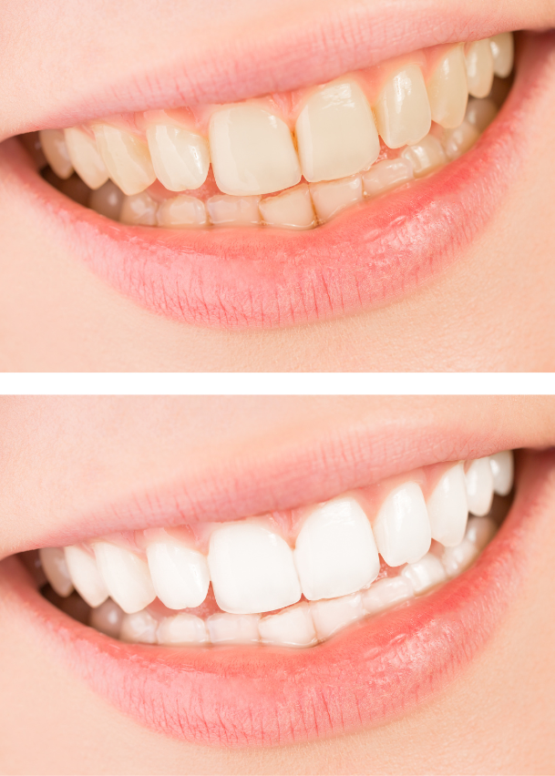 Teeth Whitening